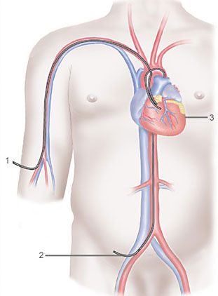 Coronary Angiography in Delhi