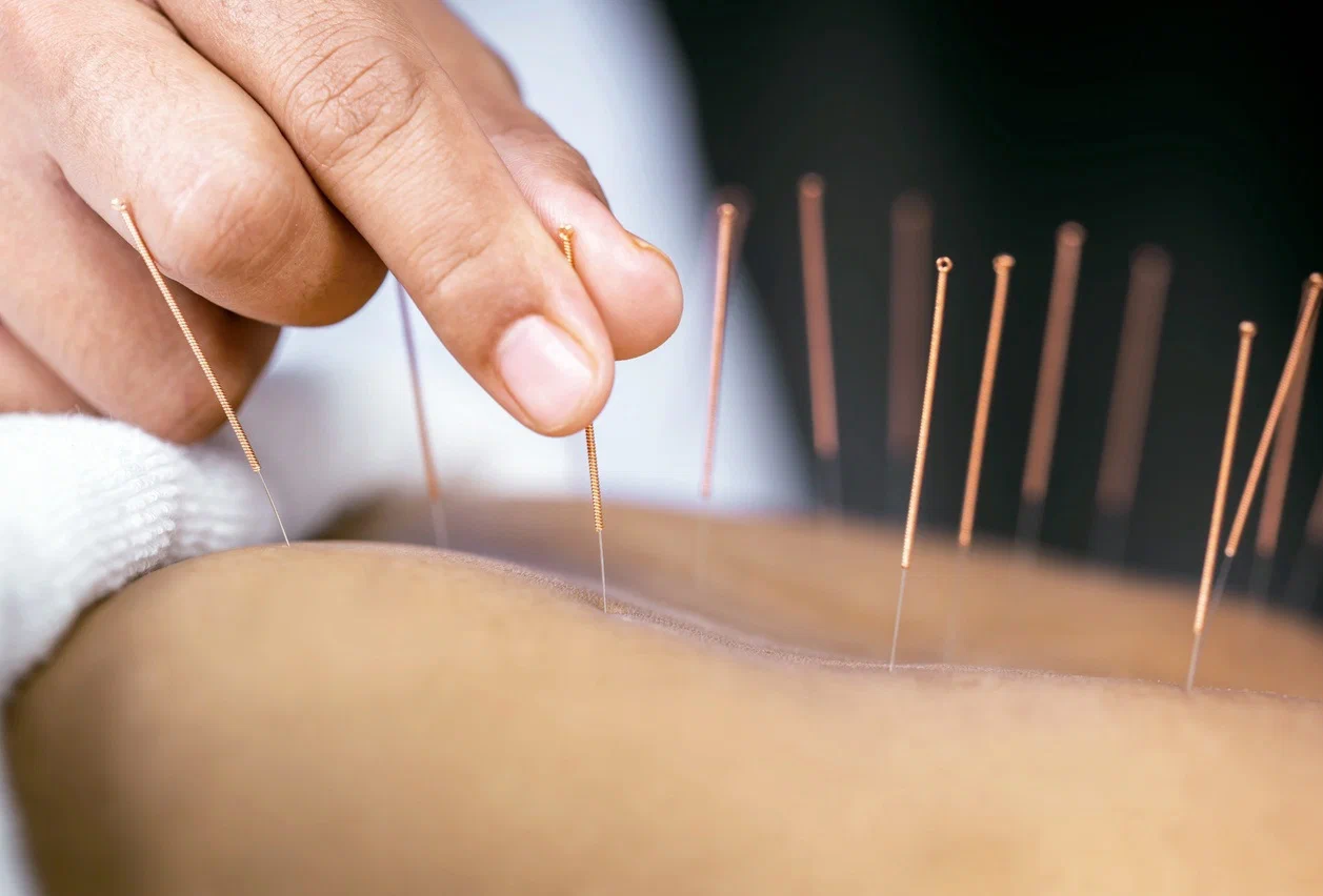 Acupuncturist